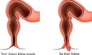 Sa trực tràng ở trẻ em có nguy hiểm?