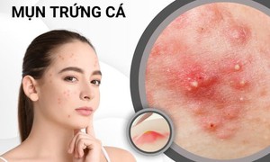 Mụn trứng cá kéo dài tới tuổi nào mới hết?