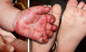Tay chân miệng tăng nhanh ở Khánh Hòa, bác sĩ khuyến cáo người dân không chủ quan