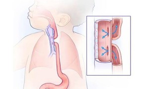 Teo thực quản bẩm sinh cần phát hiện sớm