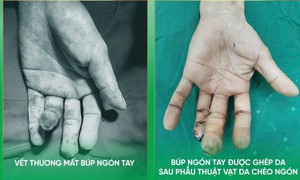 Thêm giải pháp tạo hình cho người bị khuyết hổng đầu ngón tay