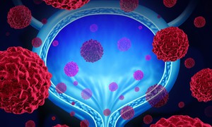 FDA bật đèn xanh cho phác đồ đột phá điều trị ung thư bàng quang mới