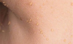 Vì sao mụn thịt thường mọc quanh mắt, xử trí thế nào?