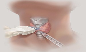Phát hiện nhân tuyến giáp có nhất thiết phải chọc hút tế bào?
