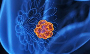 5 bí quyết giúp bạn chủ động phòng ngừa ung thư vú
