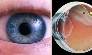 Mắt nhìn xa bị nhòe là biểu hiện của bệnh gì?