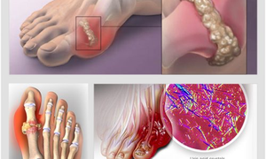 Bị bệnh gout có nên ăn cá?
