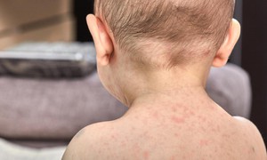 Mỹ đối mặt nguy cơ bùng phát dịch sởi tồi tệ nhất sau 35 năm