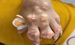 Nhiễm khuẩn huyết do vết loét hạt tophi: Biến chứng chết người từ thói quen của người bệnh gút