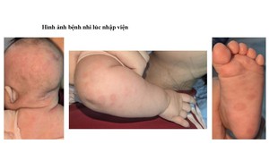 Bé gái 2 tháng tuổi mắc giang mai, nhầm sang viêm da cơ địa