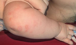 Bé gái 2 tháng tuổi mắc giang mai, nguy cơ nghiêm trọng nếu không được phát hiện