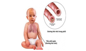 Viêm tiểu phế quản cấp ở trẻ cần phát hiện sớm