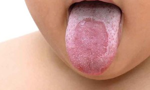 Những yếu tố làm tăng nguy cơ mắc lưỡi bản đồ