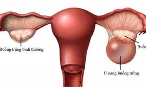 U nang buồng trứng ác tính có chữa được không?