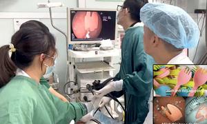 Cắn gãy thìa nhựa khi ăn sữa chua, bé 20 tháng tuổi phải nhập viện cấp cứu
