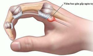 Ngón tay đau hoặc bật lò xo, cảnh giác với viêm gân gấp ngón tay