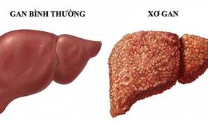 Chưa bị xơ gan vẫn có thể mắc ung thư gan