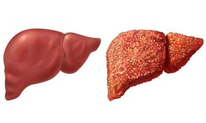 3 biến chứng nguy hiểm của tình trạng tăng men gan