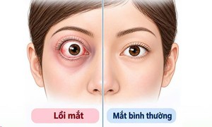 Mắt lồi, mất thị lực do khối u nằm sâu sau nhãn cầu