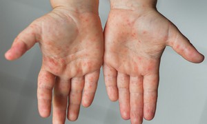 Dung dịch sát khuẩn tay chân miệng cho trẻ loại nào an toàn, giá tốt?