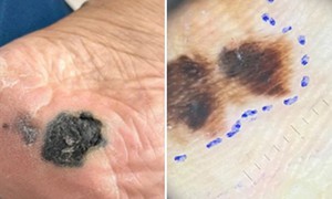 Mảng đen dưới lòng bàn chân: Dấu hiệu ung thư da dễ bị bỏ qua