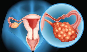 Chảy máu âm đạo bất thường, cảnh giác với ung thư buồng trứng