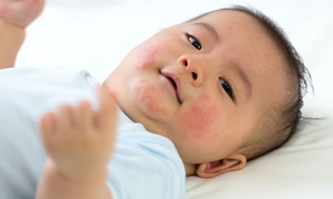 Làm sao biết con bạn bị dị ứng sữa?