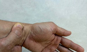  4 nguyên nhân gây đau cổ tay