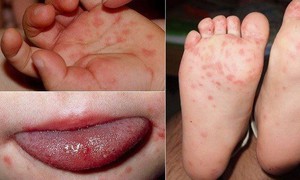 Trẻ đã từng mắc tay chân miệng vẫn có thể mắc lại
