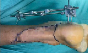 20 năm đi kiễng vì gót chân không chạm đất, chàng trai được phẫu thuật thành công