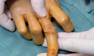 Phẫu thuật chuyển gân thành công cho bệnh nhân bị đứt gân duỗi ngón tay suốt 30 ngày