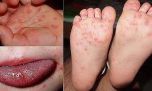 Khánh Hòa đã ghi nhận 3.688 ca tay chân miệng, bác sĩ khuyến cáo điều cần làm