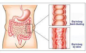 5 b&#224;i thuốc nam điều trị vi&#234;m đại tr&#224;ng mạn t&#237;nh