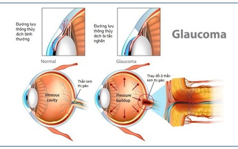 Glaucoma - &#39;Kẻ đ&#225;nh cắp&#39; thị gi&#225;c thầm lặng