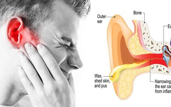 Mắc bệnh ở tai c&#243; thể g&#226;y liệt mặt v&#224; những điều cần lưu &#253;