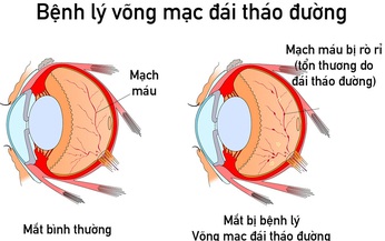 Bệnh v&#245;ng mạc đ&#225;i th&#225;o đường - Những điều cần biết