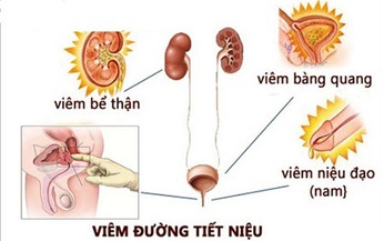 Vi&#234;m đường tiết niệu do vi khuẩn, triệu chứng v&#224; c&#225;c thuốc điều trị