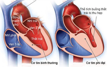 Valsartan cải thiện chức năng tim trong bệnh ph&#236; đại cơ tim