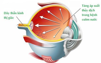 6 lưu &#253; trong sinh hoạt d&#224;nh cho người mắc bệnh Glaucoma 