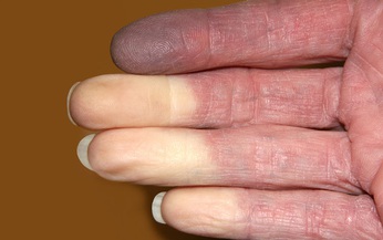 Hội chứng Raynaud l&#224; g&#236;, chữa thế n&#224;o?