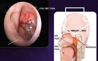 U xơ mạch v&#242;m mũi họng: Nguy&#234;n nh&#226;n, chẩn đo&#225;n v&#224; điều trị