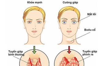 Bệnh Basedow: C&#225;c thuốc v&#224; phương ph&#225;p điều trị