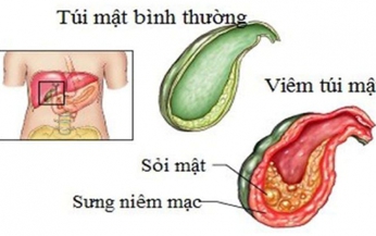 Day ấn huyệt hỗ trợ trị vi&#234;m t&#250;i mật