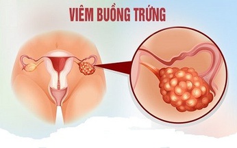 Tại sao buồng trứng bị vi&#234;m?