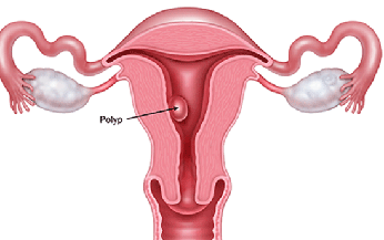 Ra huyết sau m&#227;n kinh – Cẩn thận bệnh nguy hiểm!