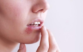 Bệnh mụn rộp sinh dục dễ nhầm với mụn nhọt thông thường