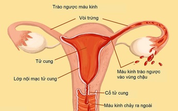 T&#236;m ra gen g&#226;y bệnh, ph&#225;t triển thuốc trị lạc nội mạc tử cung