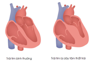 Dày thất trái - Căn bệnh nguy hiểm thường gặp ở người tăng huyết áp