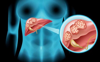 Vi&#234;m gan virus B v&#224; dự ph&#242;ng ung thư gan