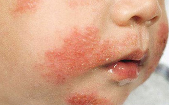 Dị ứng sữa bò ở trẻ em: Triệu chứng và cách xử trí
